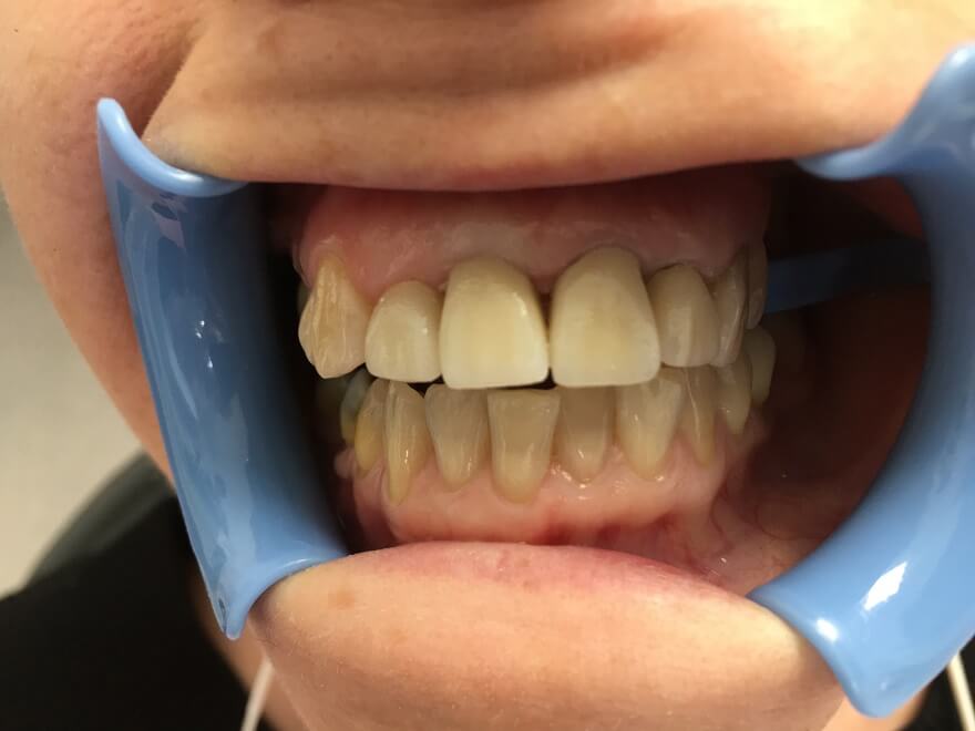Kezelésre szoruló torlódott fogak - Kosztolányi Dental Studio fogászat